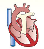 Heart Valve Repair